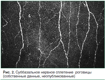 Рис. 2. Суббазальное нервное сплетение роговицы (собственные данные, неопубликованные)