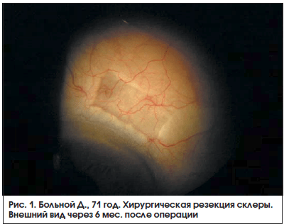Рис. 1. Больной Д., 71 год. Хирургическая резекция склеры. Внешний вид через 6 мес. после операции