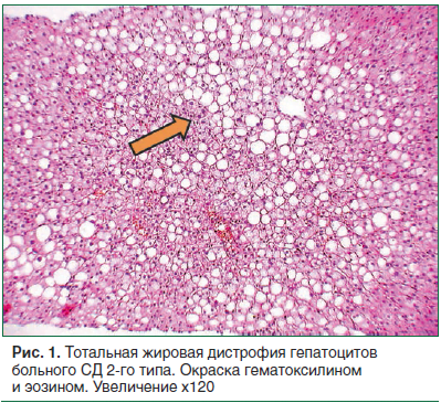 Рис. 1. Тотальная жировая дистрофия гепатоцитов больного СД 2-го типа. Окраска гематоксилином и эозином. Увеличение х120