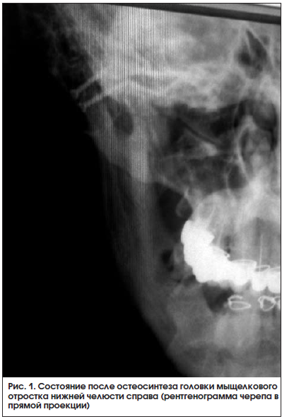 Рис. 1. Состояние после остеосинтеза головки мыщелкового отростка нижней челюсти справа (рентгенограмма черепа в прямой проекции)
