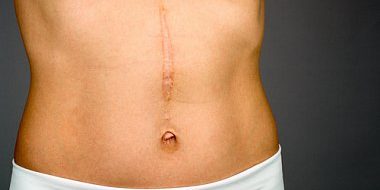 Профилактика и лечение патологических рубцов в хирургической практике | Черняков А.В.