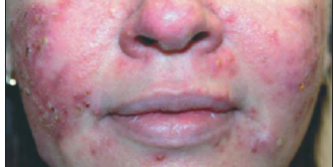 Розовые угри и родственные заболевания | Григорьев Д.В.