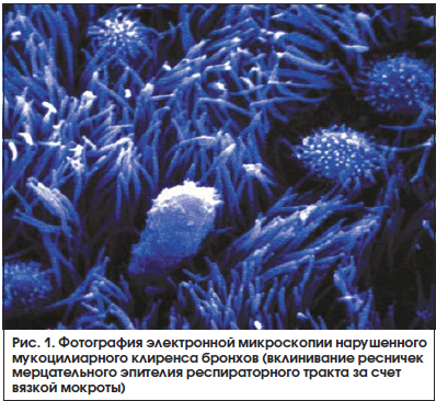 Рис. 1. Фотография электронной микроскопии нарушенного мукоцилиарного клиренса бронхов (вклинивание ресничек мерцательного эпителия респираторного тракта за счет вязкой мокроты)
