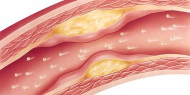 Тестостерон и атеросклероз: есть ли связь? | Кашталап В.В., Хрячкова О.Н., Шибанова И.А., Барбараш О.Л.