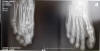Рис.3а, б.Рентгенограммы правой стопы: а— до иммобилизации, б— после 4нед иммобилизации