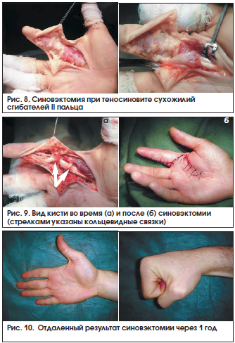 Рис. 8. Синовэктомия при теносиновите сухожилий сгибателей II пальца