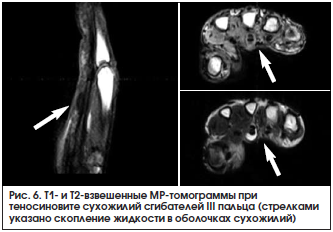 Рис. 6. Т1- и Т2-взвешенные МР-томограммы при теносиновите сухожилий сгибателей III пальца (стрелками указано скопление жидкости в оболочках сухожилий)