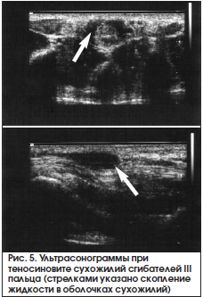 Рис. 5. Ультрасонограммы при теносиновите сухожилий сгибателей III пальца (стрелками указано скопление жидкости в оболочках сухожилий)
