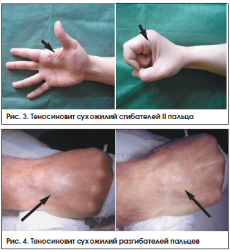 Рис. 3. Теносиновит сухожилий сгибателей II пальца