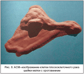 Рис. 8. АСМ–изображение клетки плоскоклеточного рака шейки матки с ороговением