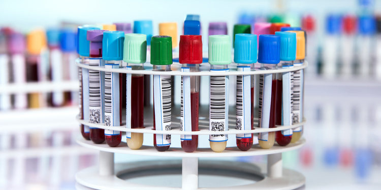 Новый тест обнаружит рак поджелудочной железы на ранних стадиях