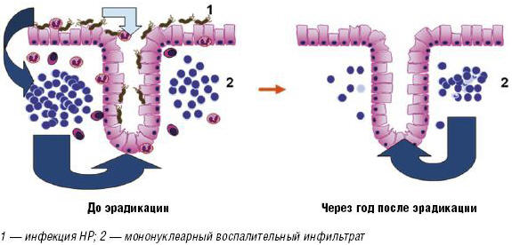 Рис. 1. Персистенция мононуклеарного воспалительного инфильтрата впостэрадикационном периоде – фактор, определяющий темпы клеточного обновления эпителиоцитов слизистой оболочки желудка