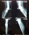 Рис.1. Рентгенограммы коленных суставов