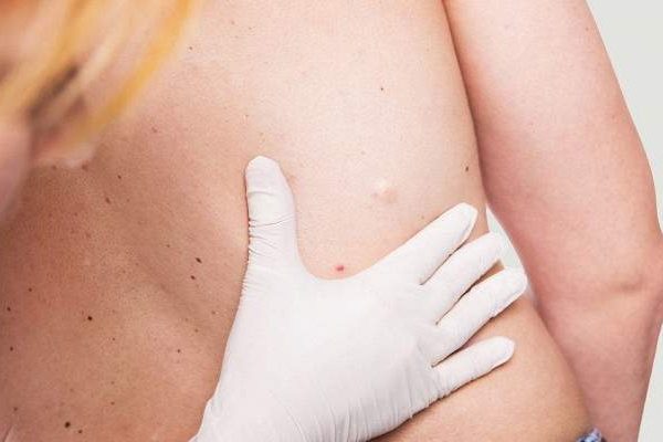 Медики рассказали, чем опасны шишки под кожей