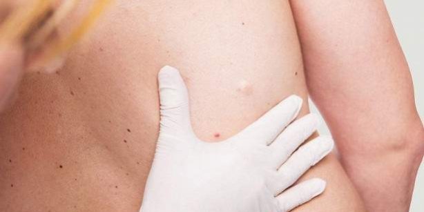 Медики рассказали, чем опасны шишки под кожей