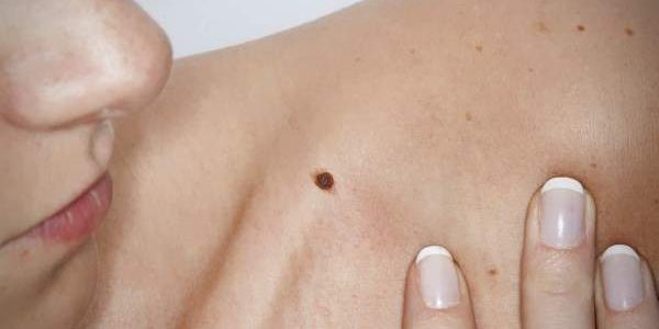 Врачи подсказали, как распознать «плохие» родинки