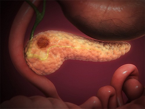 Заблуждения и факты о раке поджелудочной железы — МедНовости