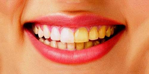 В чем причина желтизны зубов и как с ней справиться