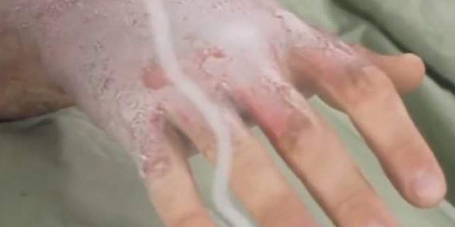 Ученые изобрели новый метод лечения ожогов