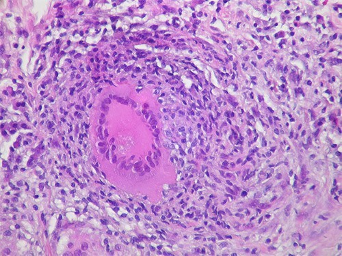 Иммунодефициты, мигранты и антипрививочники: что продолжает подпитывать туберкулез в России — МедНовости