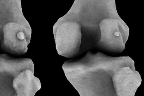 Кость, исчезнувшая века назад, вернулась и вызывает у нас боль — МедНовости