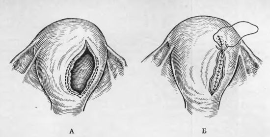 операция при разрыве матки