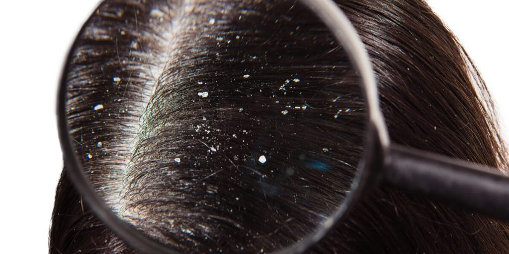 Статья о перхоти (себорее)