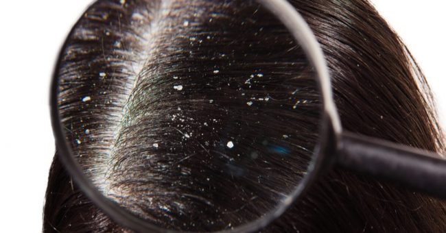 Статья о перхоти (себорее)