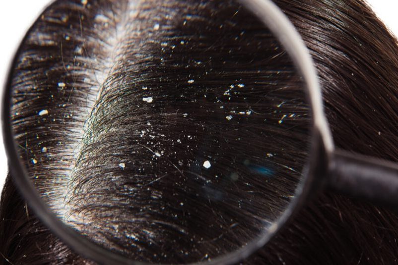 Статья о перхоти (себорее)