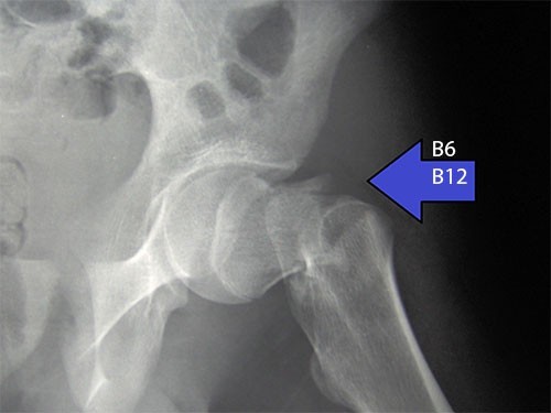 Избыточное употребление витаминов В6 и В12 увеличивает риск перелома бедра — МедНовости