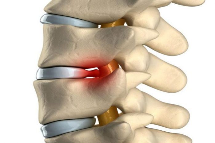 1407489944_mezhpozvonochnaya-gryzha