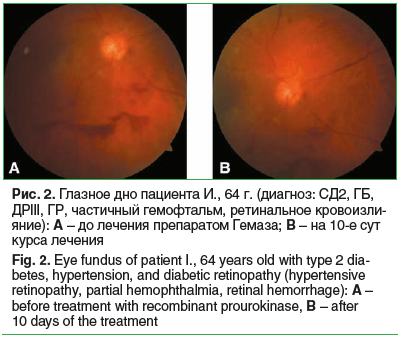 Рис. 2. Глазное дно пациента И., 64 г. (диагноз: СД2, ГБ, ДРIII, ГР, частичный гемофтальм, ретинальное кровоизли- яние): A – до лечения препаратом Гемаза; B – на 10-е сут курса лечения