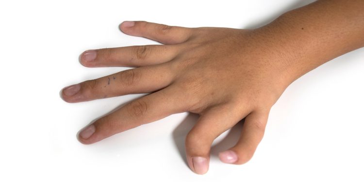 Пять пальцев хорошо, а шесть лучше: скрытые возможности полидактилии