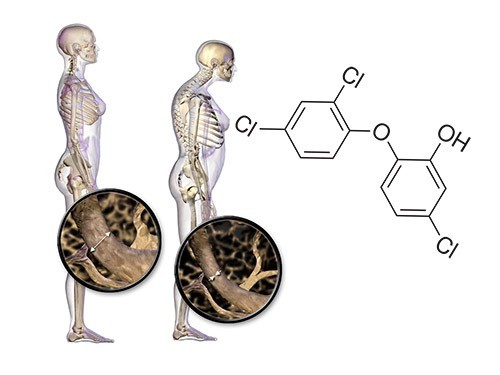 Распространенный антисептик связали с риском переломов у женщин — МедНовости