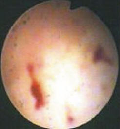 Рис. 2. Гистероскопическая картина хронического эндометрита у больной Р., 34 лет, страдающей хроническим циститом