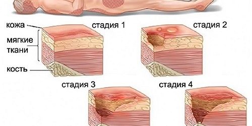 Что такое пролежни и как с ними бороться — МедНовости