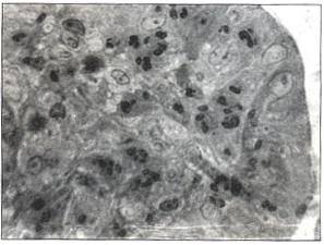 Рис. 1. Слизистая оболочка двенадцатиперстной кишки в области зарубцевавшейся язвы. В субэпителиальной зоне - плазматические клетки, находящиеся в апоптозе. Полутонкий срез. Окраска метиленовым синим. 