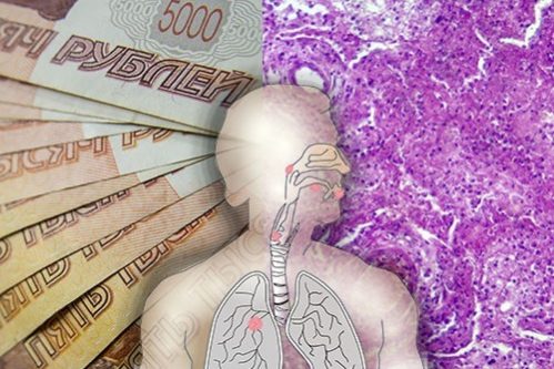 Большинство россиян считает лечение рака легкого слишком дорогим и поэтому малодоступным — МедНовости