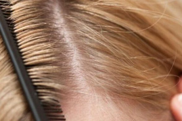 Эти простые советы помогут навсегда избавиться от перхоти