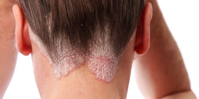 Дерматологи подсказали, как вылечить псориаз в домашних условиях