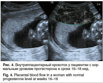 Рис. 4. Внутриплацентарный кровоток у пациентки с нормальным уровнем прогестерона в сроке 16–18 нед.