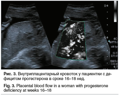 Рис. 3. Внутриплацентарный кровоток у пациентки с дефицитом прогестерона в сроке 16–18 нед.