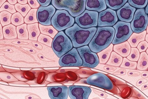 Псориаз связали с увеличением риска нескольких видов рака — МедНовости