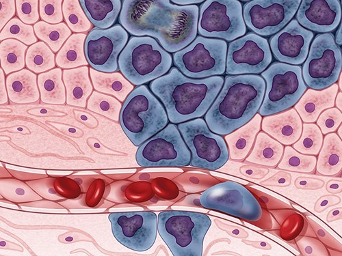 Псориаз связали с увеличением риска нескольких видов рака — МедНовости