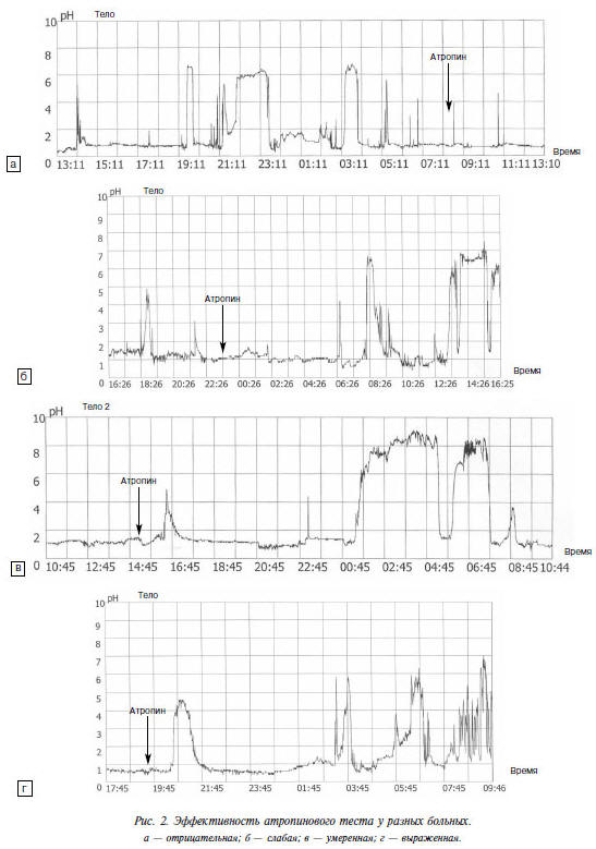 Рис. 2. Эффективность атропинового теста у разных больных. а — отрицательная; б — слабая; в — умеренная; г — выраженная
