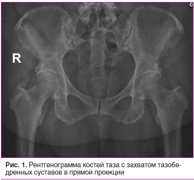 Рис. 1. Рентгенограмма костей таза с захватом тазобедренных суставов в прямой проекции