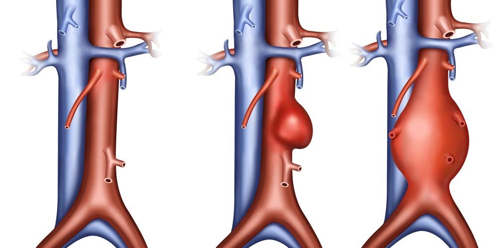 Симптомы и опасность каждого периода атеросклероза