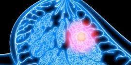 Как диагностировать фиброму молочной железы