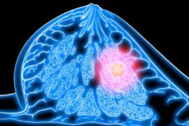 Как диагностировать фиброму молочной железы