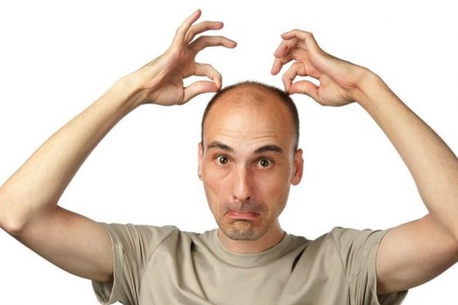 Стало известно, какие мужчины раньше лысеют